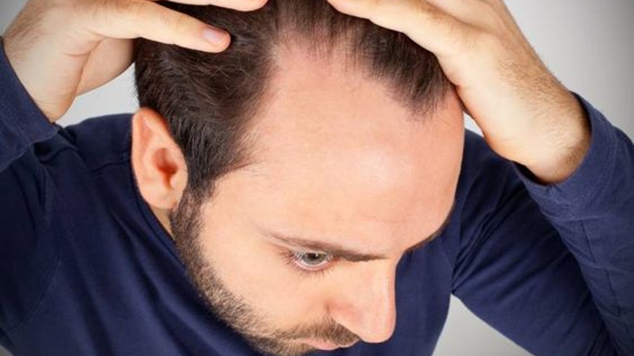 habitos que causan alopecia