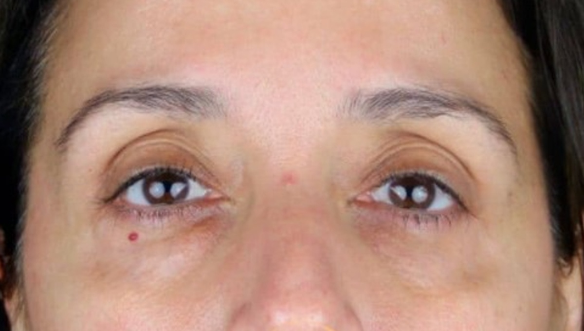 remedios caseros para combatir los parpados caidos