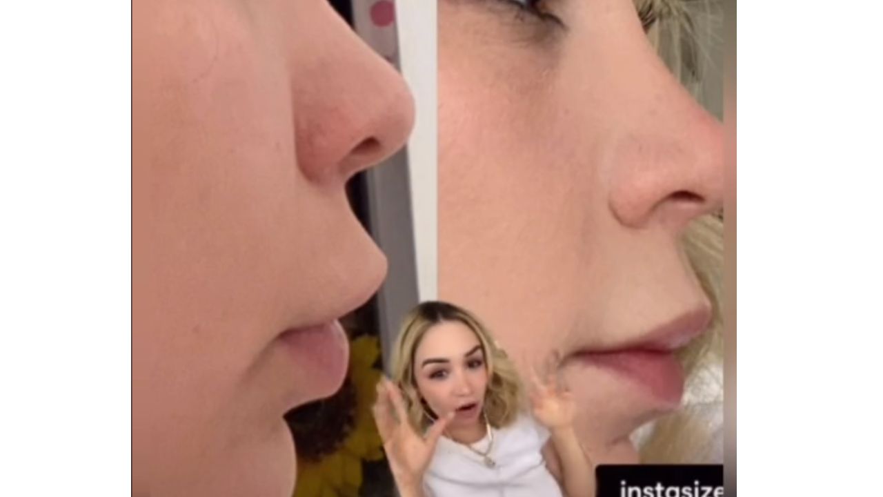 Migración de relleno de labios