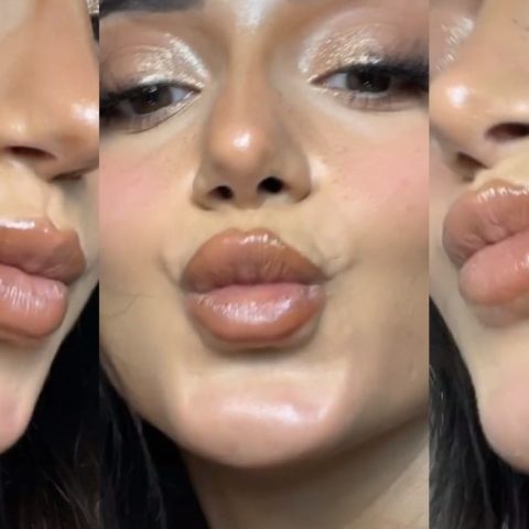 Migración de relleno de labios