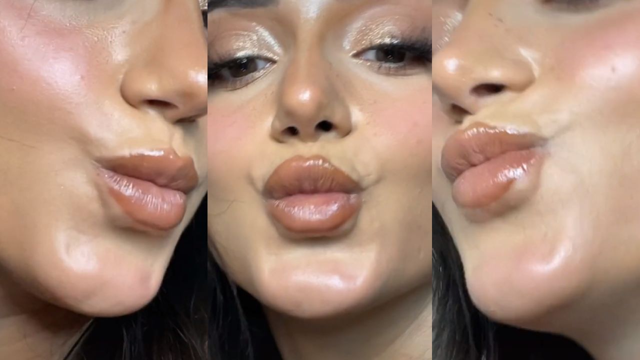 Migración de relleno de labios