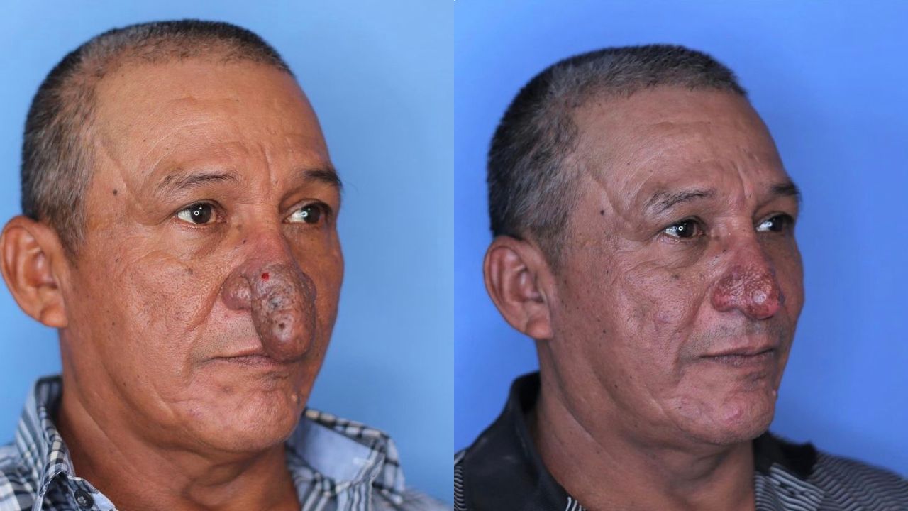 Cirujano ofrece cirugía de nariz