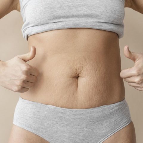 Rascarse la panza en el embarazo causa estrías