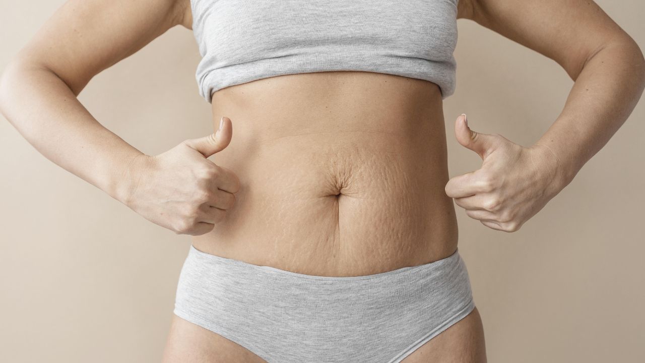 Rascarse la panza en el embarazo causa estrías