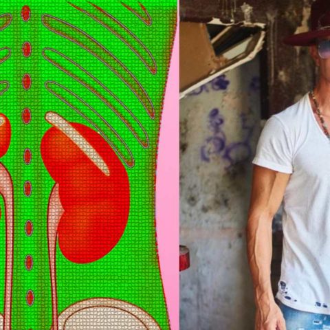 que es la agenesia renal