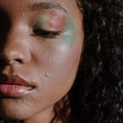 origen emocional de acne