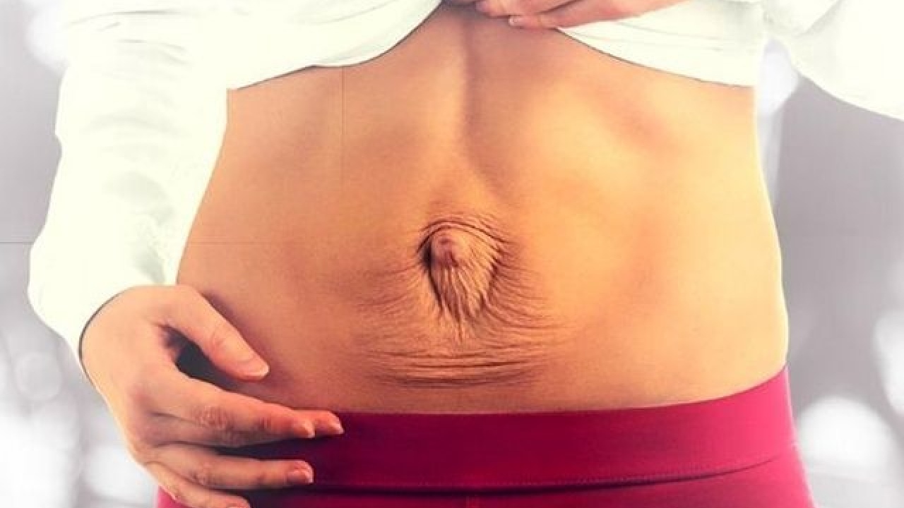 cuando hacer abdominoplastia