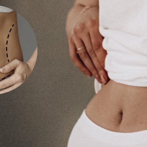 que es abdominoplastia