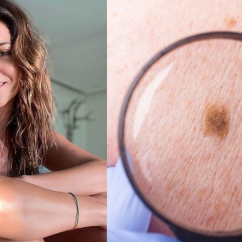 Sintomas de melanoma