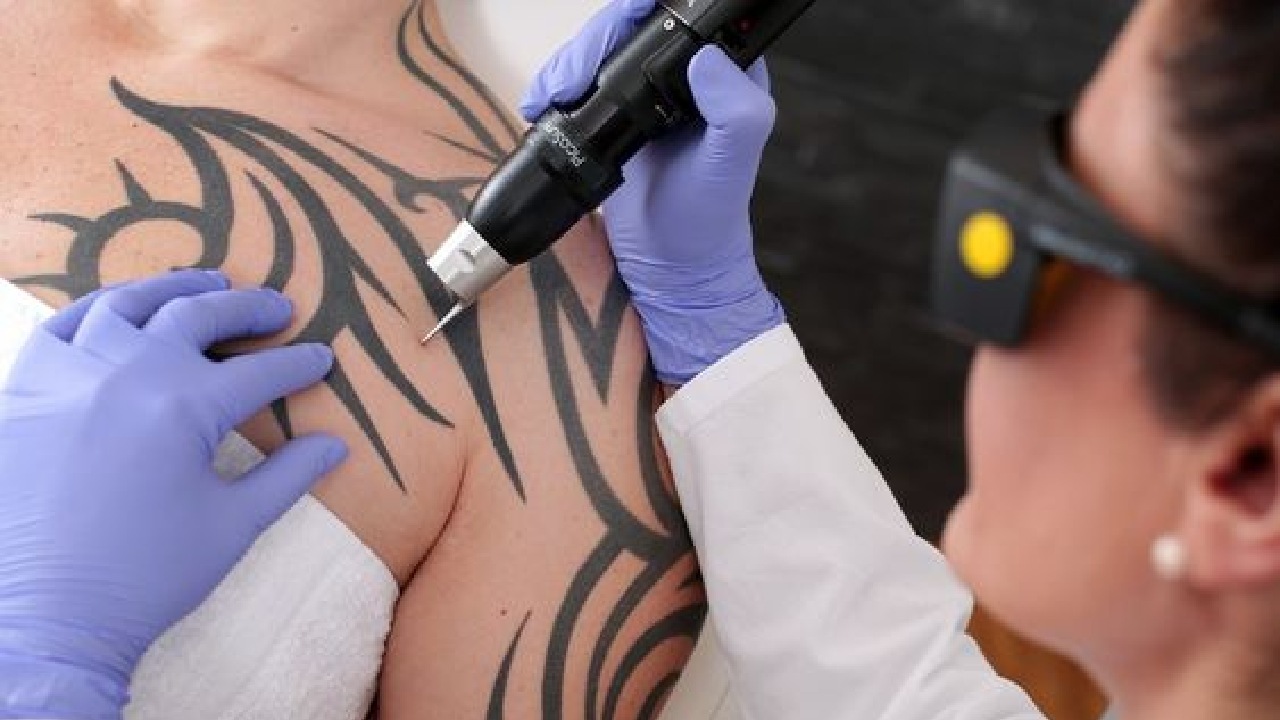 como eliminar tatuaje