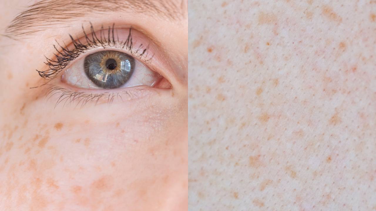 manchas en la piel vitaminas para combatirlas