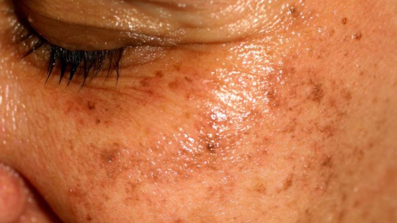 manchas en la piel vitaminas