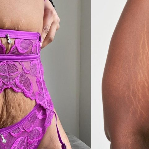 mujeres con estrias y flacidez