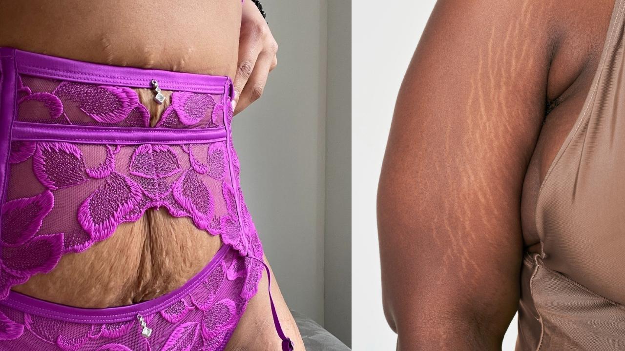 mujeres con estrias y flacidez