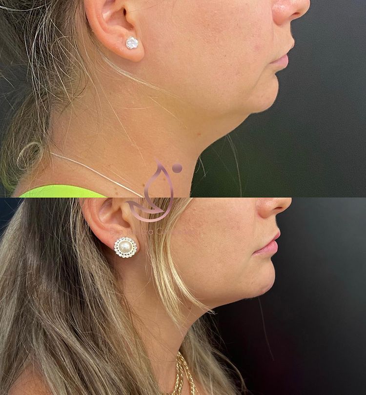 como disimular la papada en mujeres