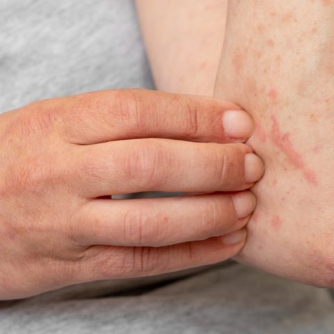 dermatitis atópica