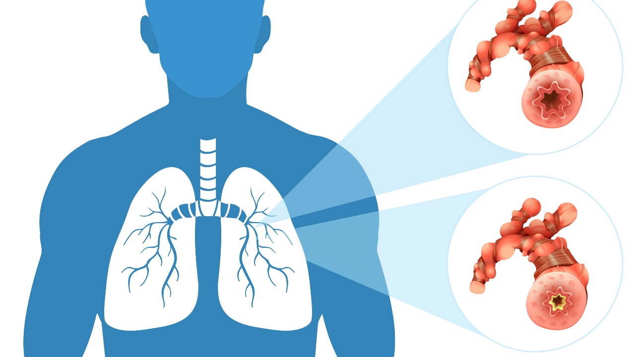 embolia pulmonar sintomas