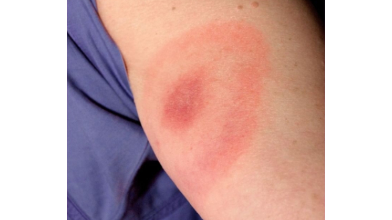 imágenes de picaduras de arañas