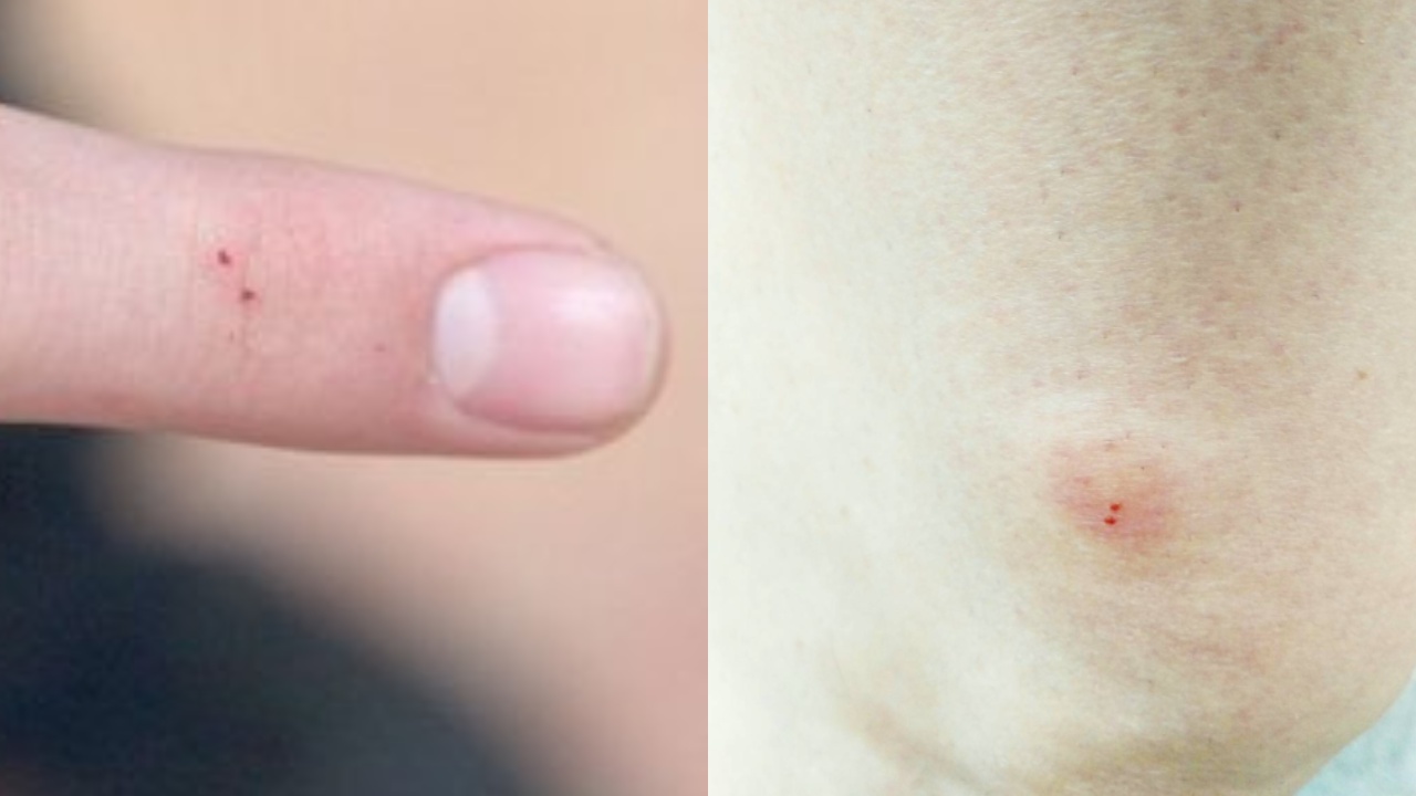 imágenes de picaduras de arañas