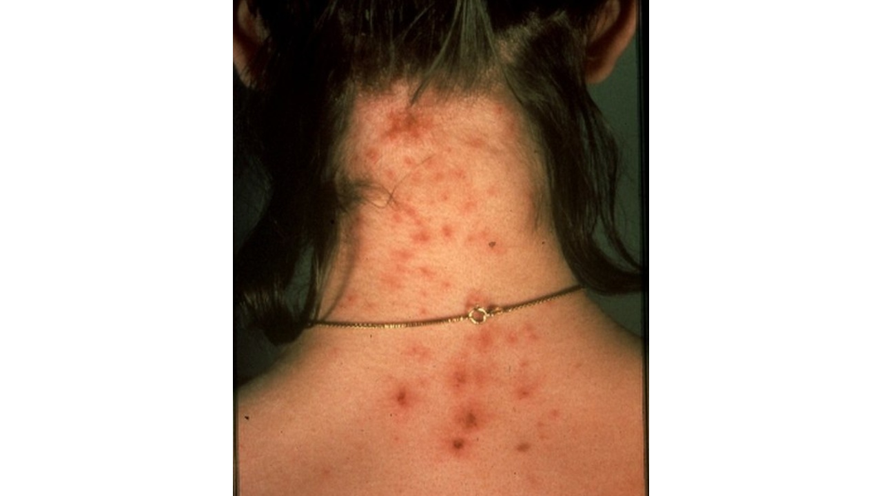 imágenes de picaduras de arañas