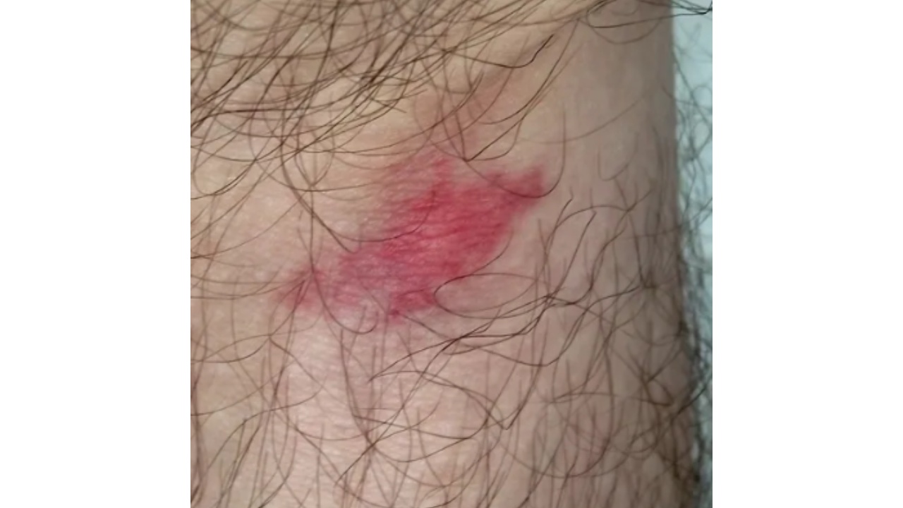 imágenes de picaduras de arañas