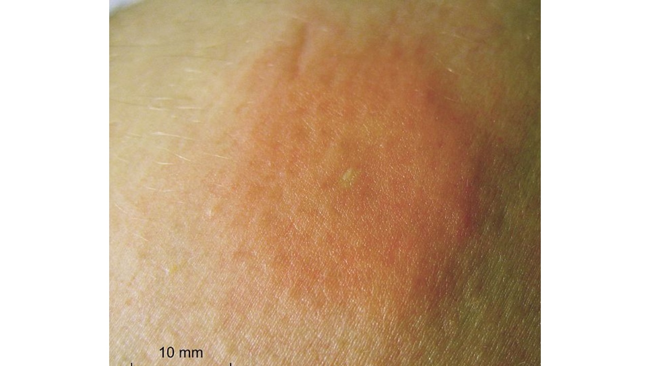 imágenes de picaduras de arañas