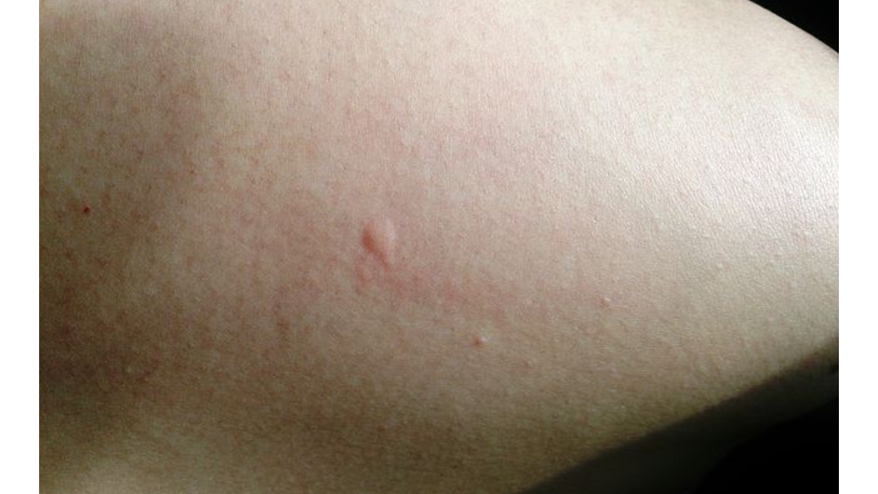 imágenes de picaduras de arañas