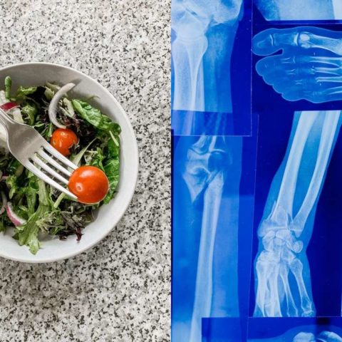 Qué comer si tienes osteoporosis