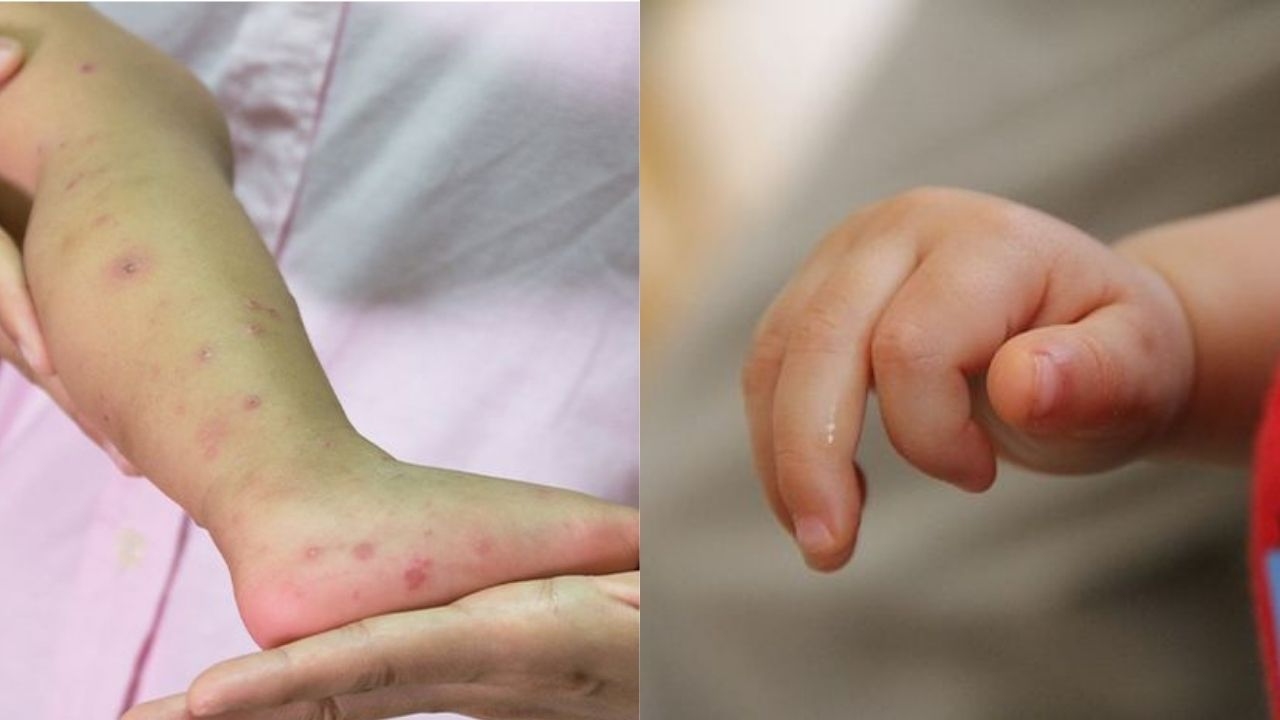 como prevenir virus Coxsackie