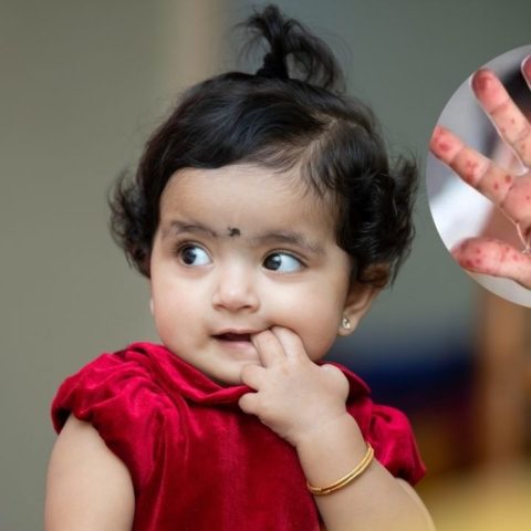 que es virus Coxsackie