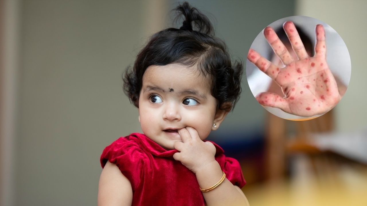 que es virus Coxsackie