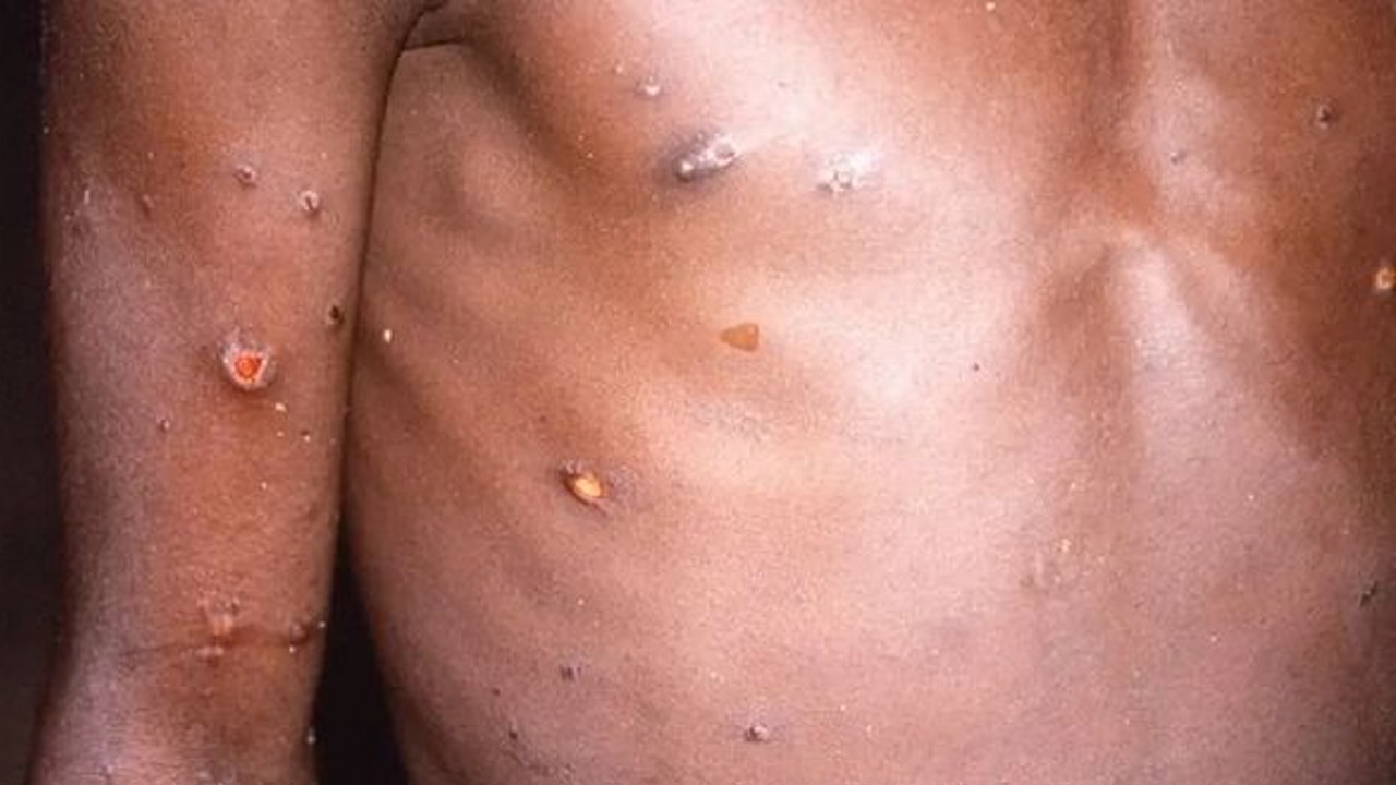 Síntomas de la viruela de mono