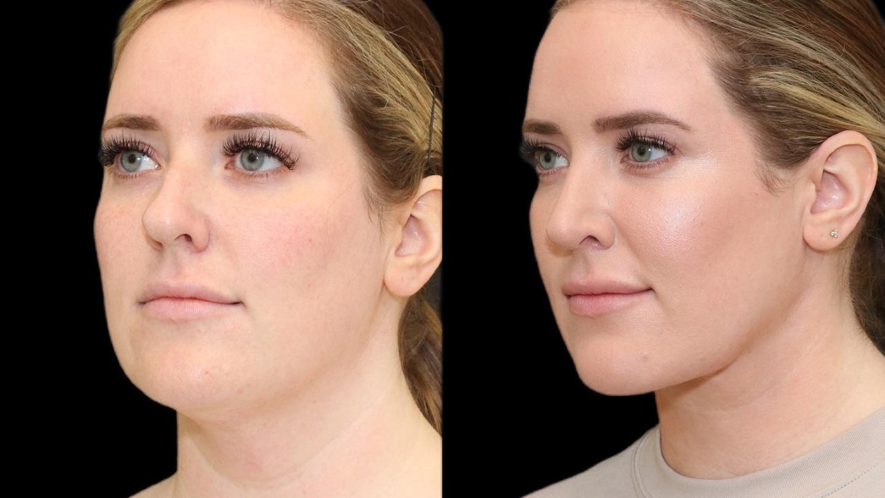 metodo coreano para eliminar la papada