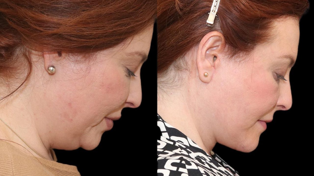 ejercicios para eliminar la papada