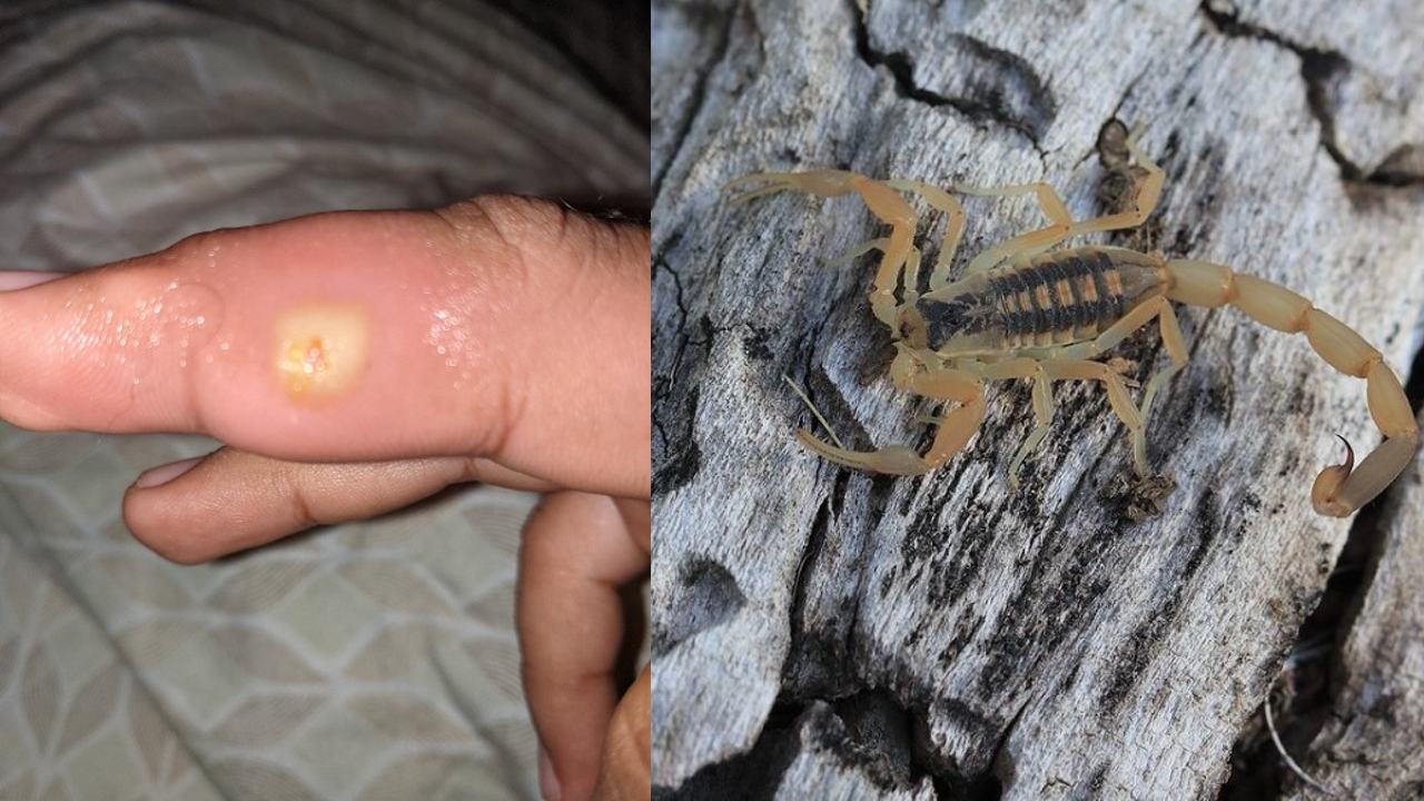 remedios caseros para picadura de alacrán