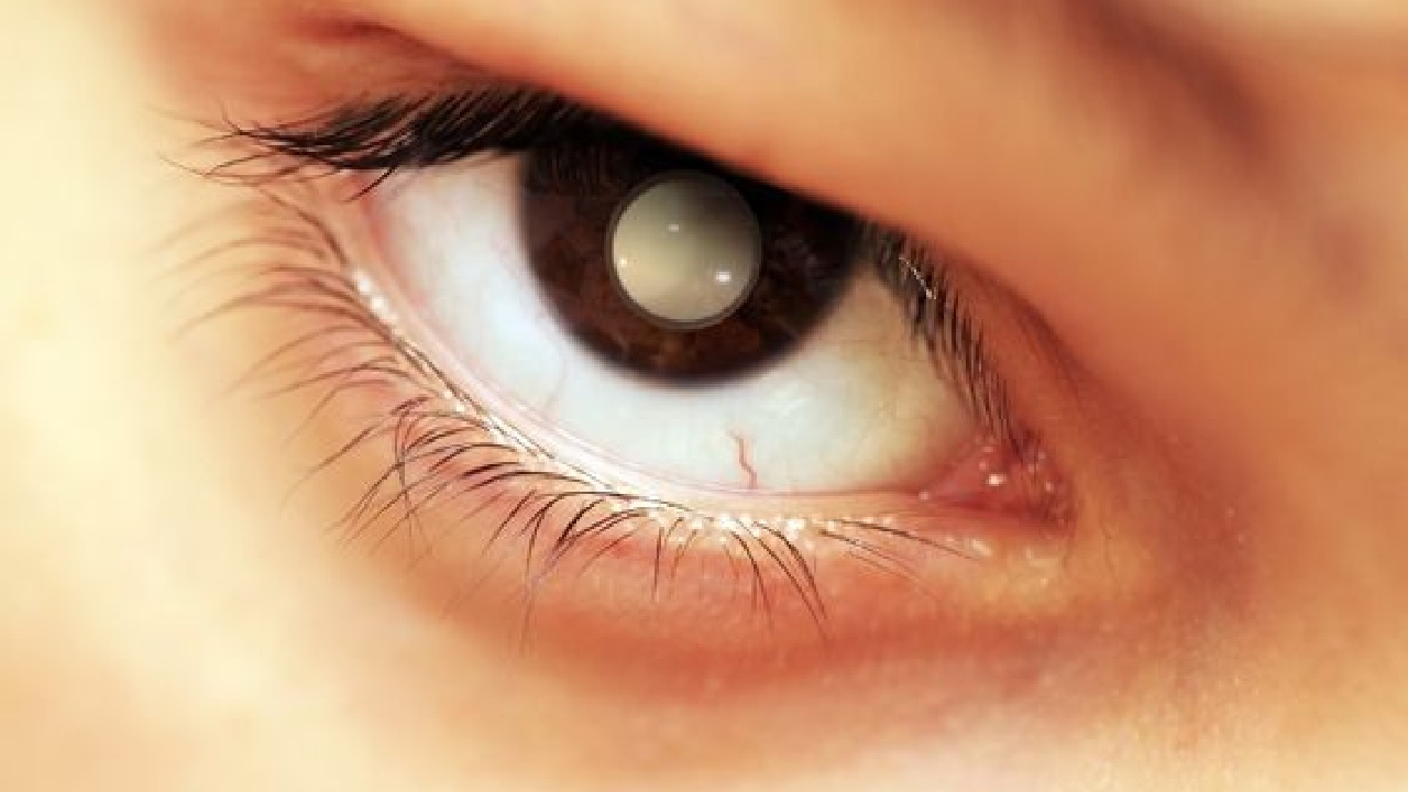 como saber si tu hijo tiene retinoblastoma