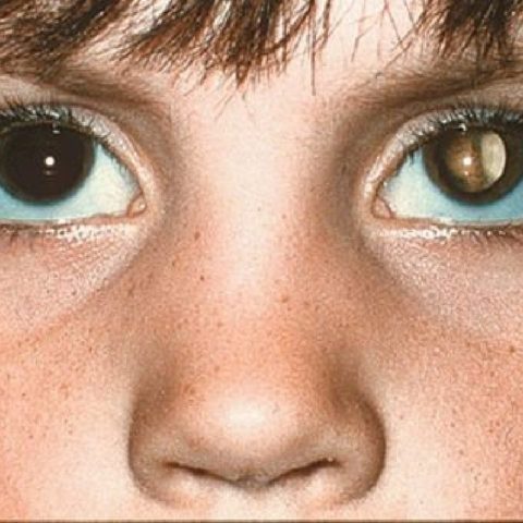 como saber si tu hijo tiene cancer en el ojo