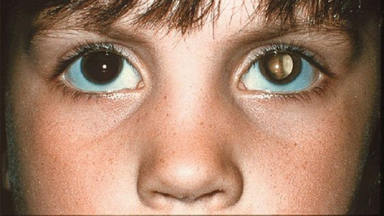 como saber si tu hijo tiene cancer en el ojo