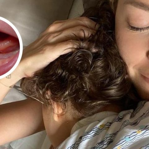 frenillo lingual corto