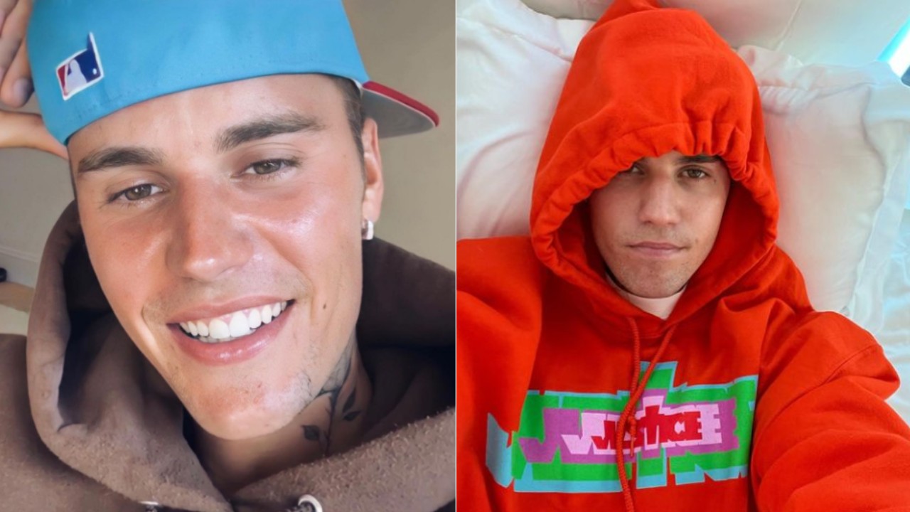 síndrome de Ramsay Hunt, enfermedad de Justin Bieber