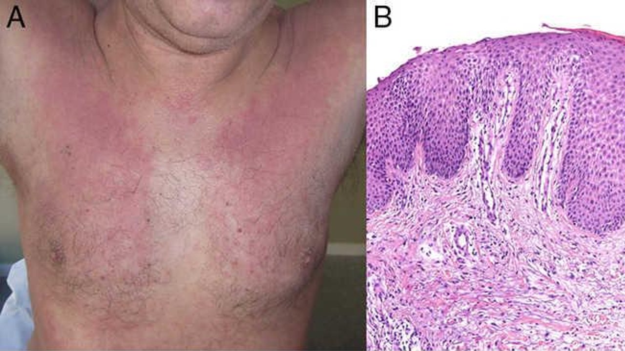 erupción cutánea llamada Papuloeritrodermia de Ofuji