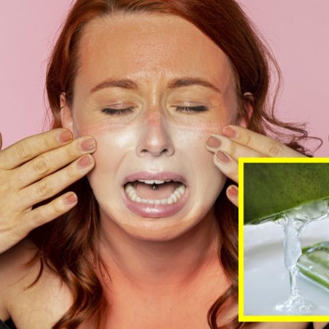 sábila para quemaduras solares