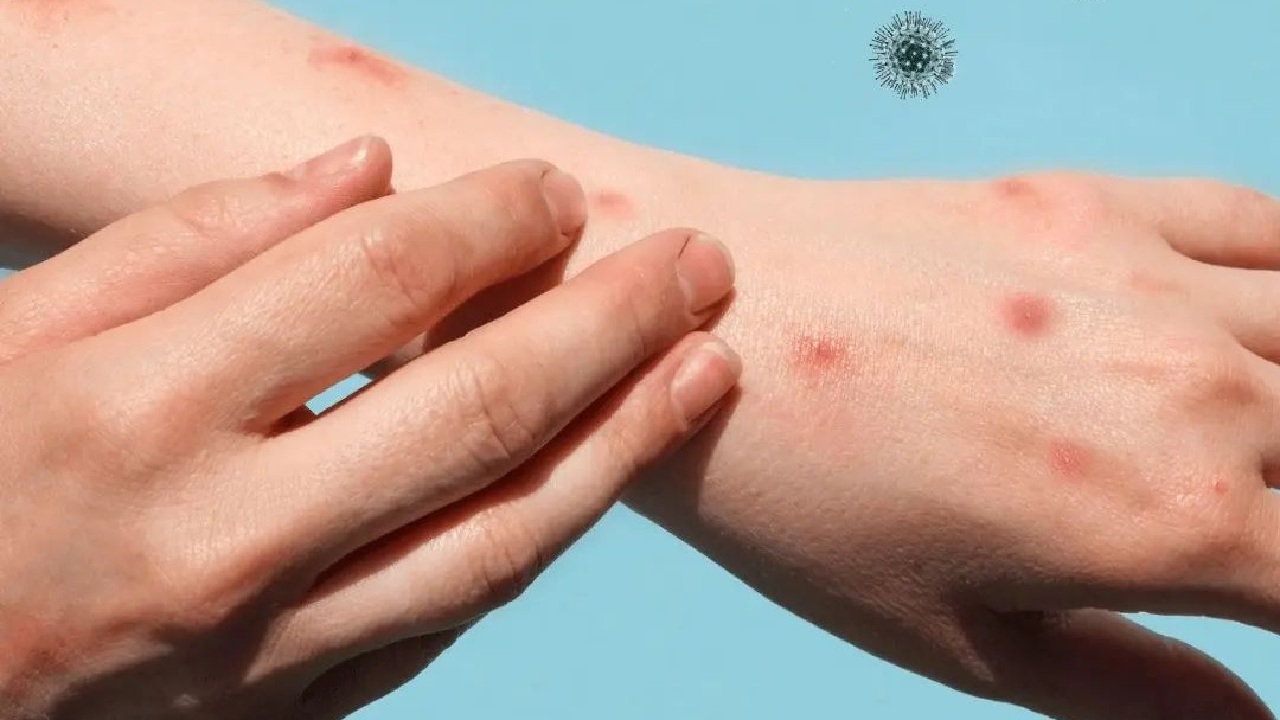 vacuna viruela del mono