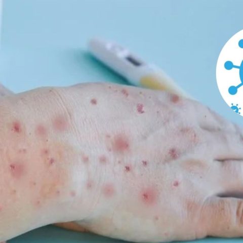 viruela del mono tratamiento