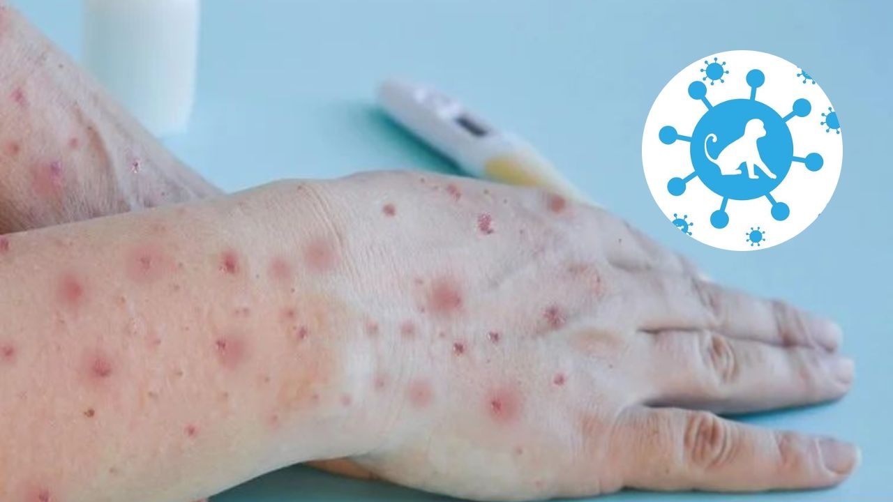 viruela del mono tratamiento