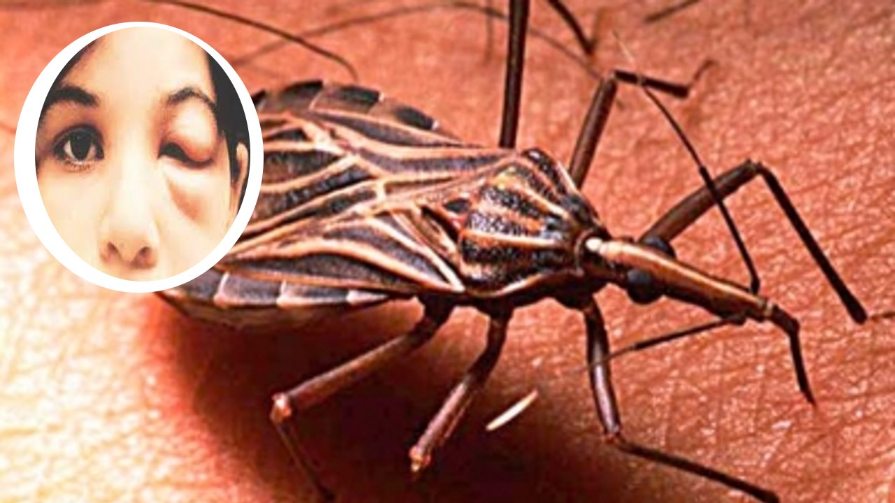 enfermedad de chagas