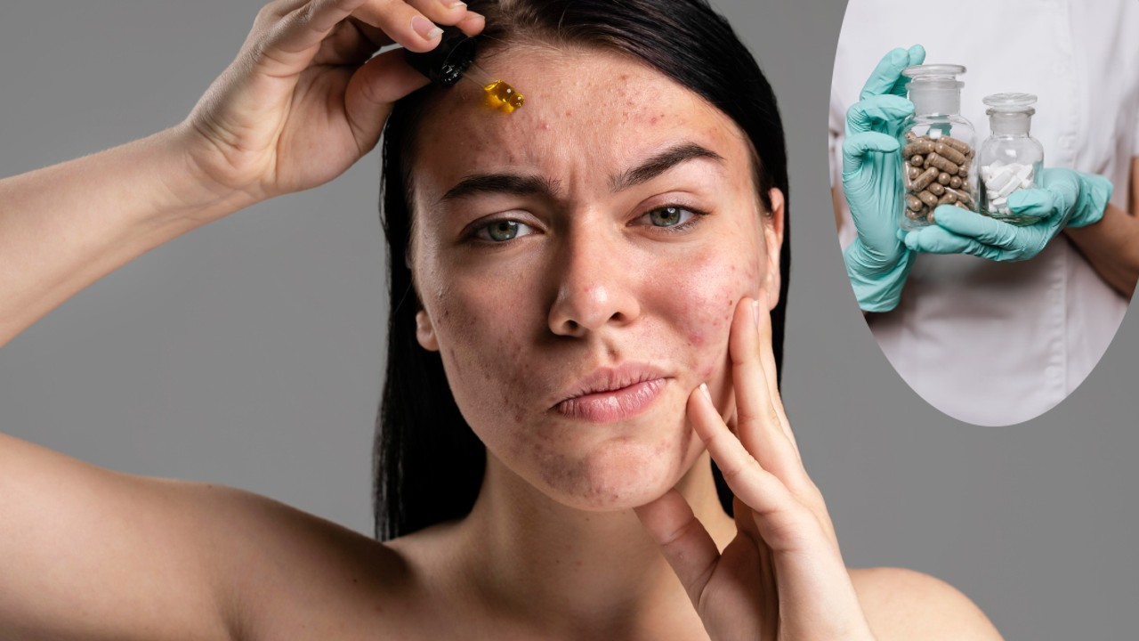 Acné podría ser provocado por las vitaminas que tomas