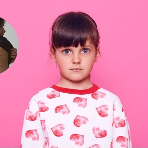 viruela del mono en ninos