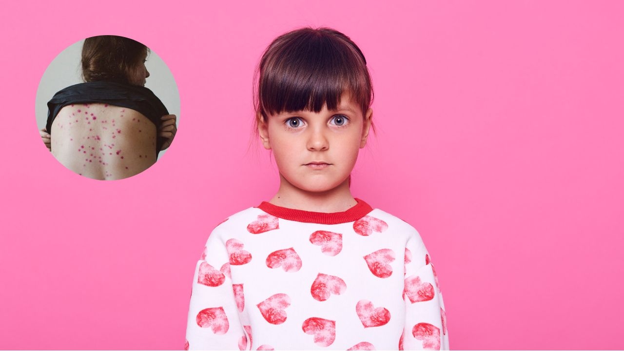 viruela del mono en ninos