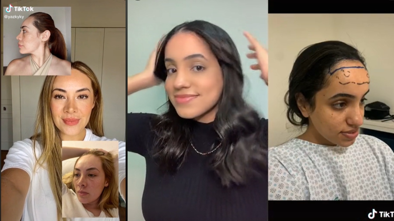 Frontoplastía la cirugía para reducir frente